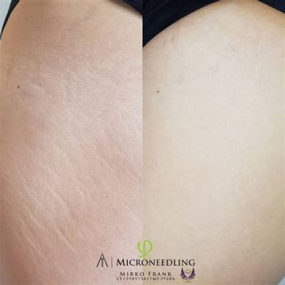 Does Microneedling Work for Stretch Marks? And How Can It Help?